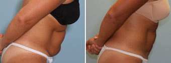 Vaser Lipo Abdomen 912950
