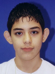 Otoplasty Ear Surgery - Male Child before 818040