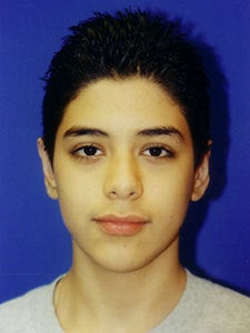 Otoplasty Ear Surgery - Male Child after 818040