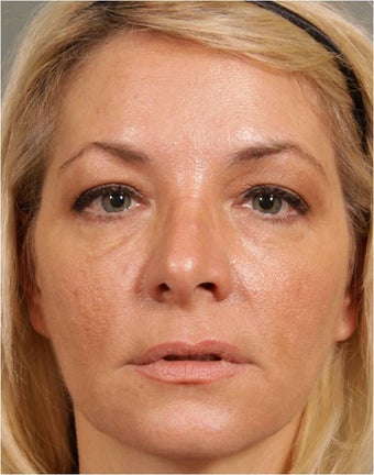 47 year old female treated for loss of volume under eyes, cheeks, and lips after 791059