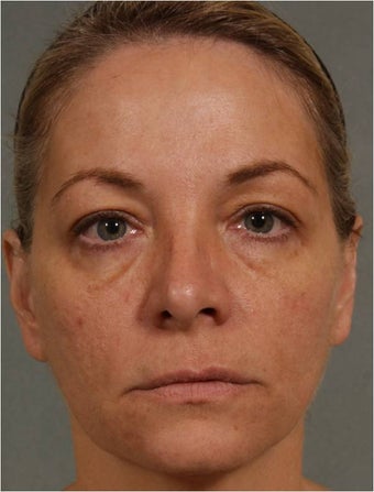 47 year old female treated for loss of volume under eyes, cheeks, and lips before 791059
