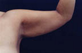 hidden scar arm lift after 892458