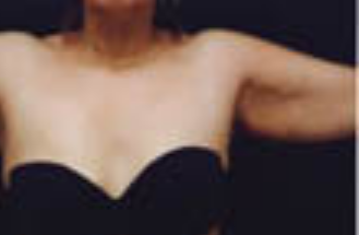 hidden scar arm lift before 892458