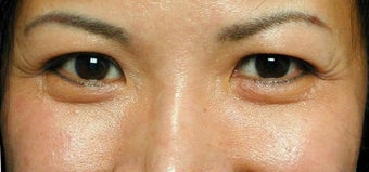 Crows feet before 968630