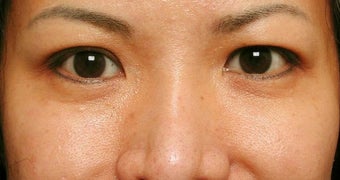 Crows feet after 968630