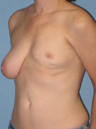 Breast Reconstruction before 963244