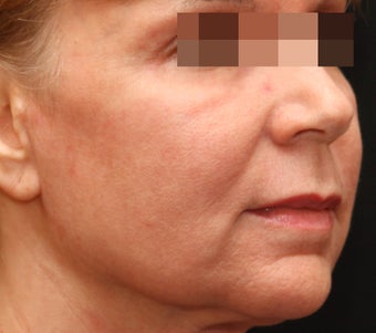 Fraxel Repair for Wrinkles and Sun Damage after 123682