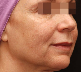 Fraxel Repair for Wrinkles and Sun Damage before 123682