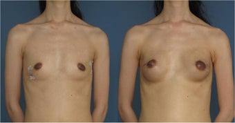 Breast Reconstruction, Nipple Sparing before 1033573