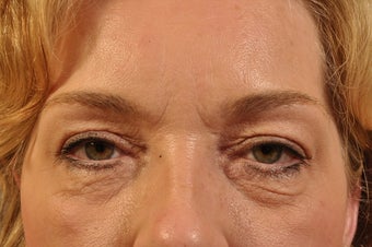 Lower Lid Hetter Peel before 857627