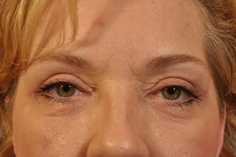 Lower Lid Hetter Peel after 857627