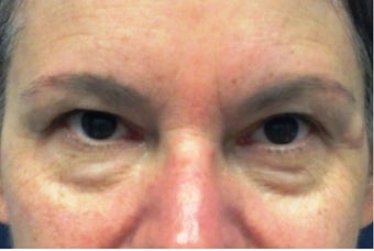 53 yr old female treated with dermal filler below eyes before 1328563