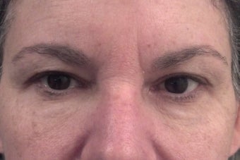 53 yr old female treated with dermal filler below eyes after 1328563