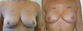 Scarless Breast Lift before 1197685
