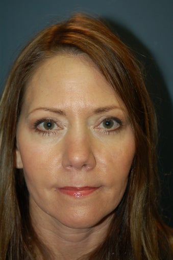 Nose Surgery after 928999