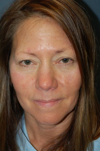 Nose Surgery before 928999