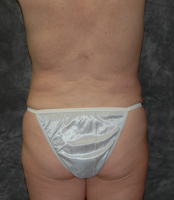 Vaser Liposuction after 929475