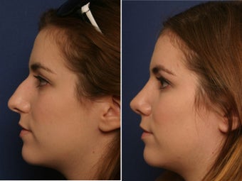 Nose before 425053