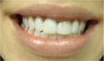 Zoom! Laser Whitening after 326055
