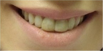 Zoom! Laser Whitening before 326055