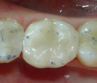 Silver Filling Replaced by Composite Filling after 905919