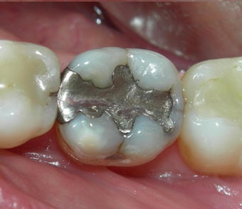 Silver Filling Replaced by Composite Filling before 905919