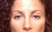 Rhinoplasty after 130769