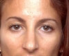 Rhinoplasty before 130769