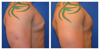 Young Male Treated for Large Breasts after 1367257
