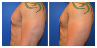 Young Male Treated for Large Breasts 1367257