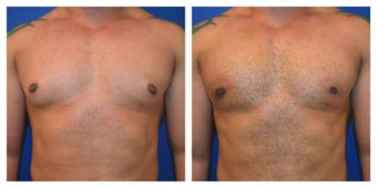 Young Male Treated for Large Breasts before 1367257