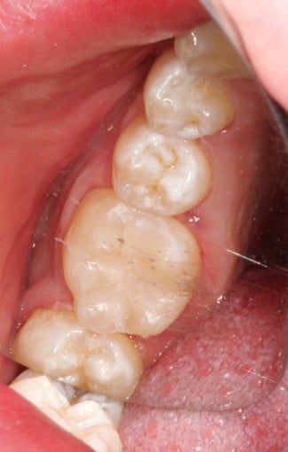 Replacement of Silver Amalgam Fillings with Tooth-Colored Composite Fillings after 948895