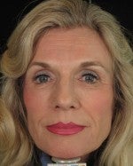 Artefill Dermal Filler after 1206585