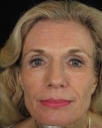 Artefill Dermal Filler before 1206585
