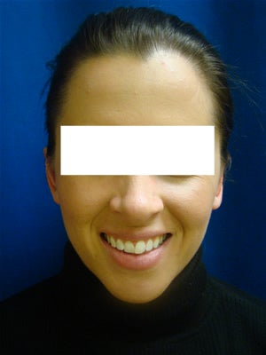Ear Surgery (otoplasty) after 135291