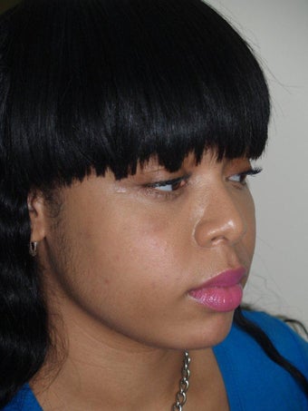Before and After Buccal Fat Removal 689778