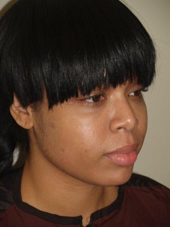Before and After Buccal Fat Removal 689778