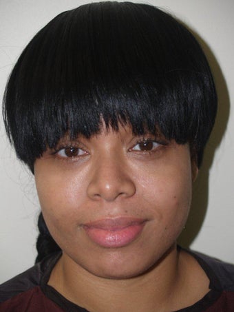 Before and After Buccal Fat Removal before 689778