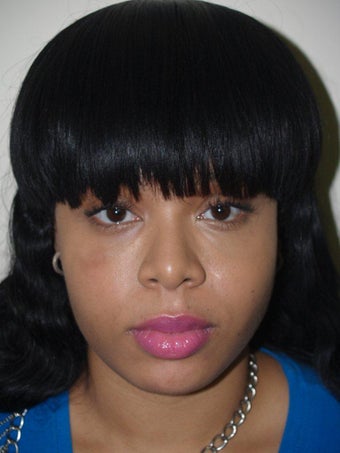 Before and After Buccal Fat Removal after 689778