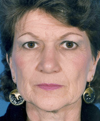 Facelift before 507827