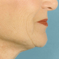 Facelift 507827
