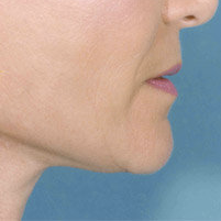 Facelift 507827