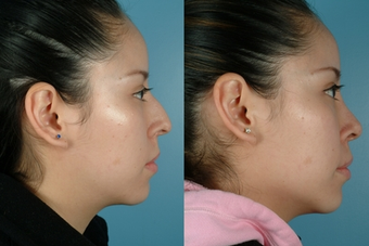 Revision Rhinoplasty before 302686