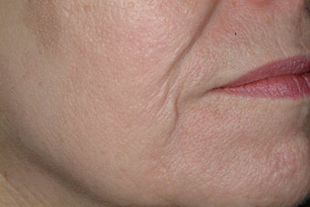 Acne scars treated with Fraxel after 86776