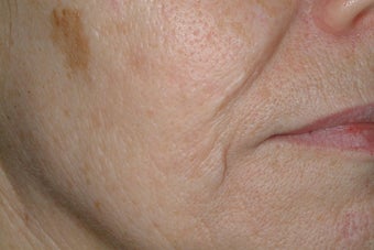 Acne scars treated with Fraxel before 86776