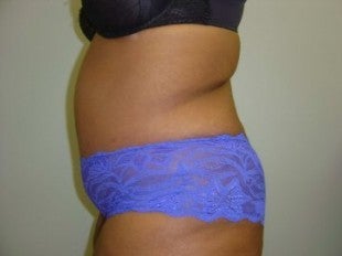 40 year old lady with excess skin after gastric bypass - side view after 621313