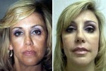 49 Year Old Before and After Fat Grafting and Sculptra to the Cheeks before 712603
