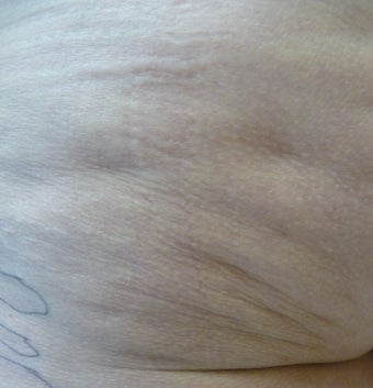 Cellulite Treatment before 638402