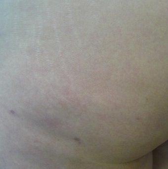 Cellulite Treatment after 638402