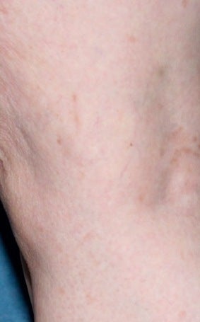 Sclerotherapy after 370424